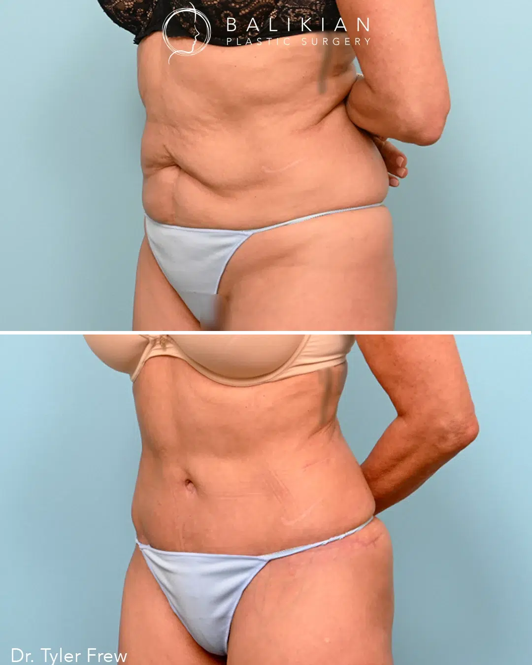 Before and after angled side view of tummy tuck with liposuction by Dr. Tyler Frew showing a tighter, contoured abdomen.