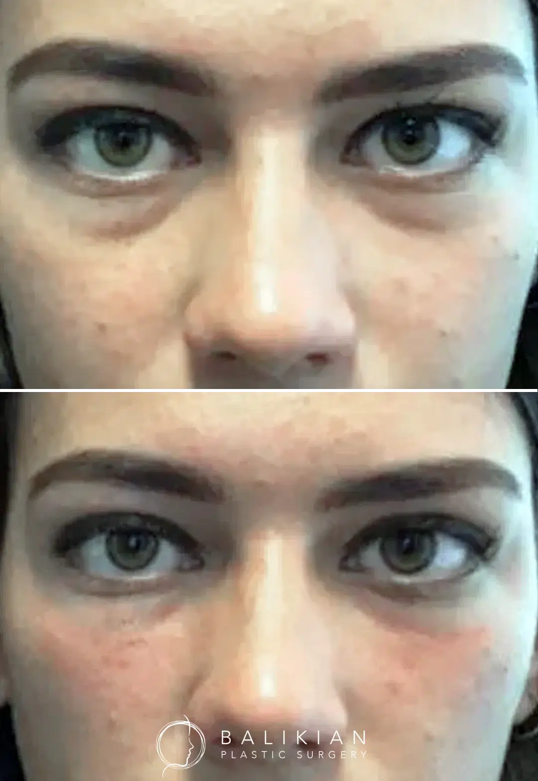 Under-eye filler used to restore lost volume. Post-treatment shows less shadowing and a rejuvenated appearance.