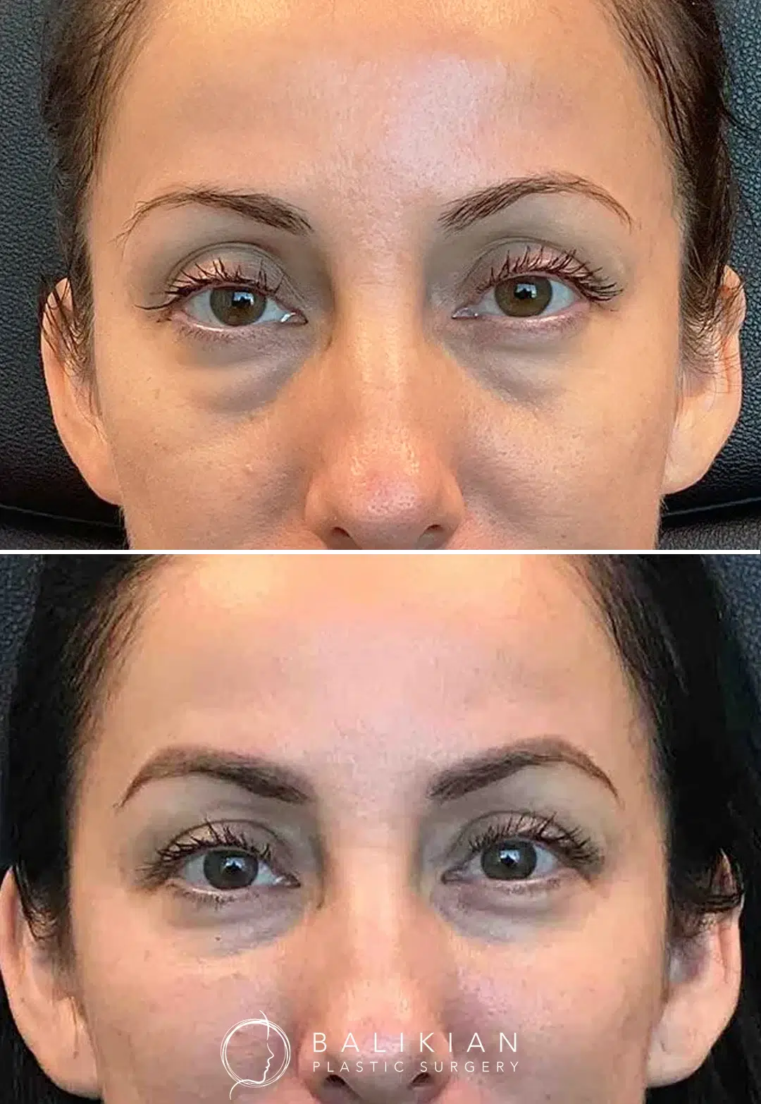 Under-eye filler to reduce hollowness and dark circles. Post-treatment shows smoother tear troughs and a refreshed look.
