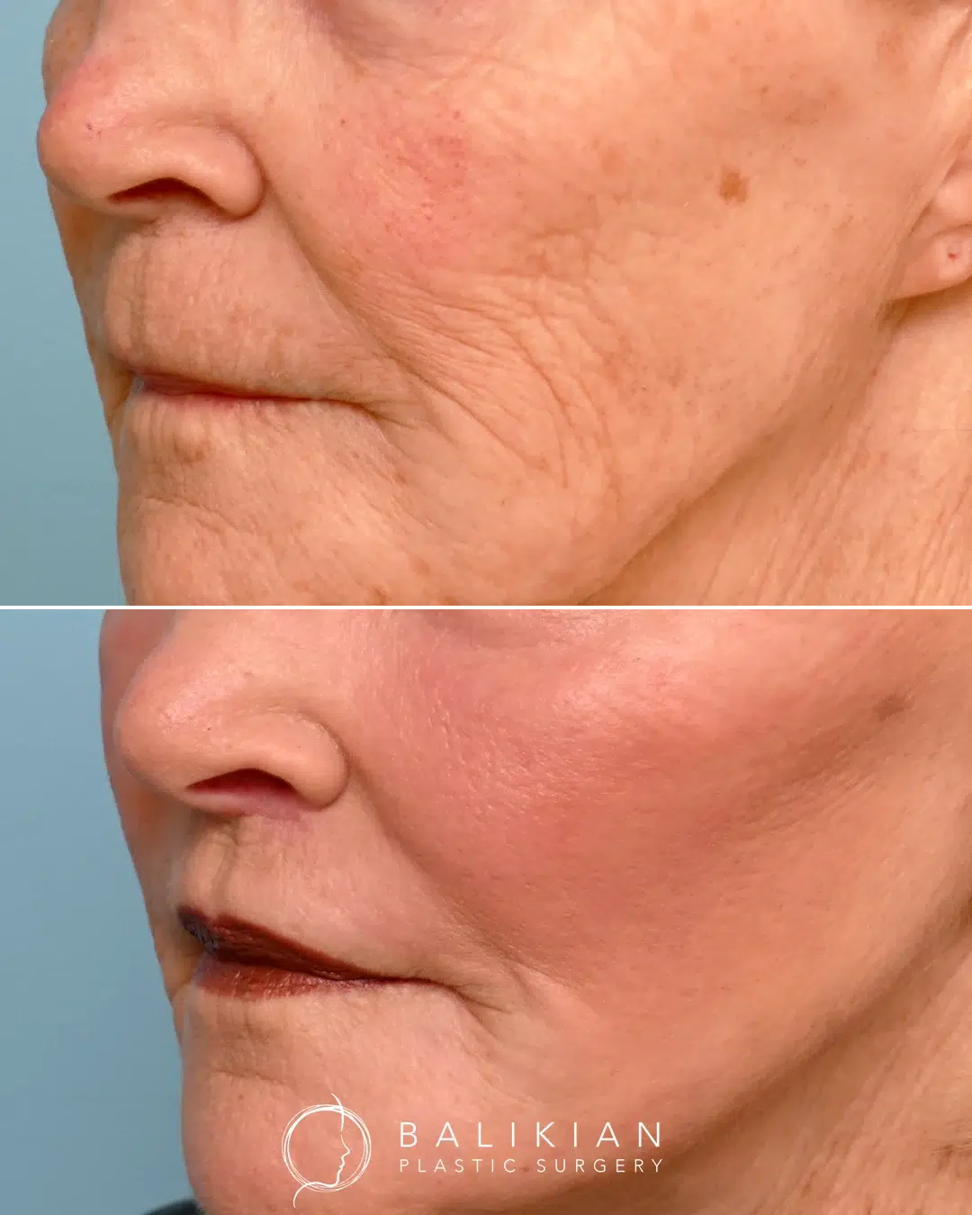 Upper lip lift before and after angled profile with more visible pink lip and refined upper lip definition.