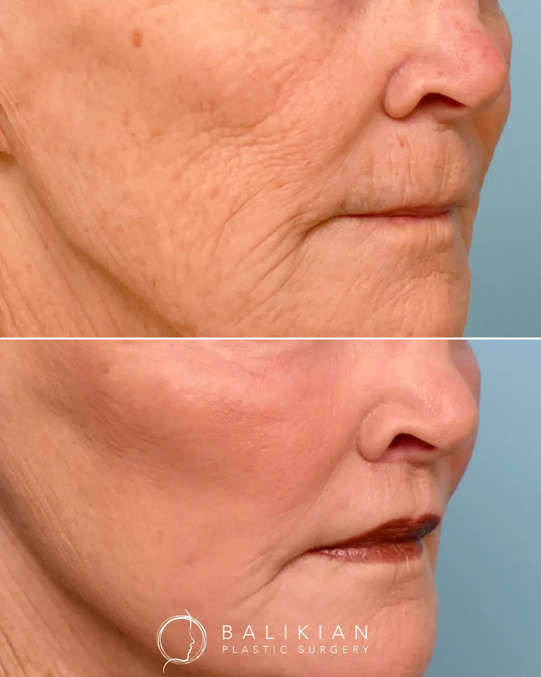 Upper lip lift before and after close-up highlighting youthful lip shape and improved vertical balance between nose and lip.