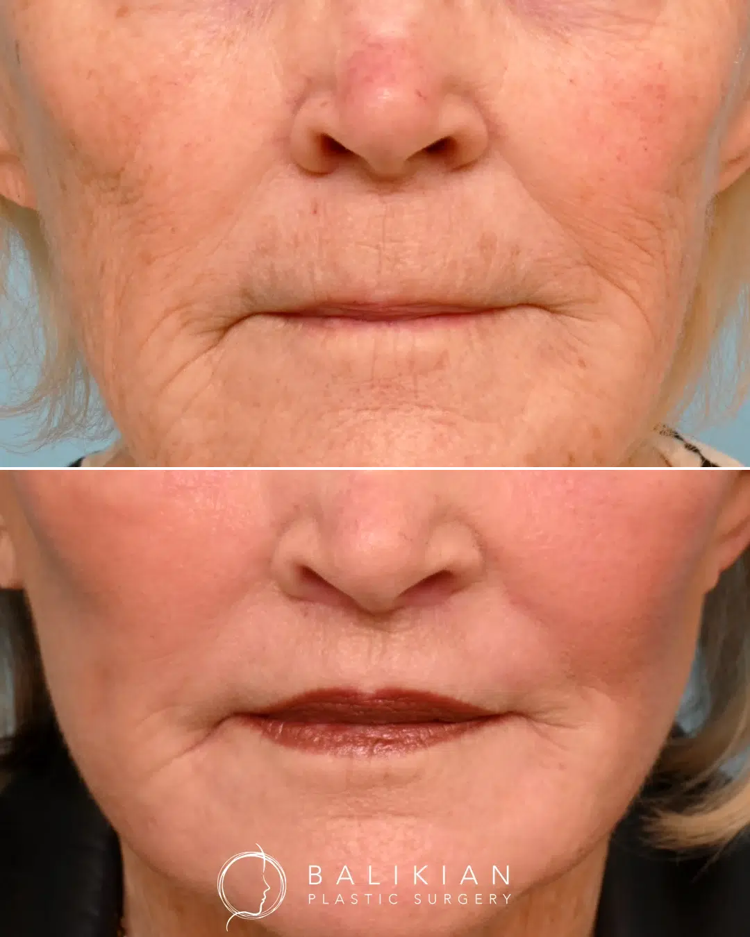 Lip lift before and after front view showing enhanced symmetry, fuller lips, and natural smile rejuvenation.