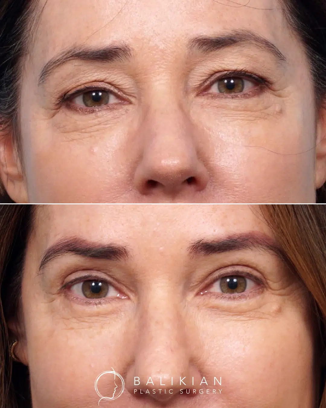 Upper and lower blepharoplasty before and after front view.