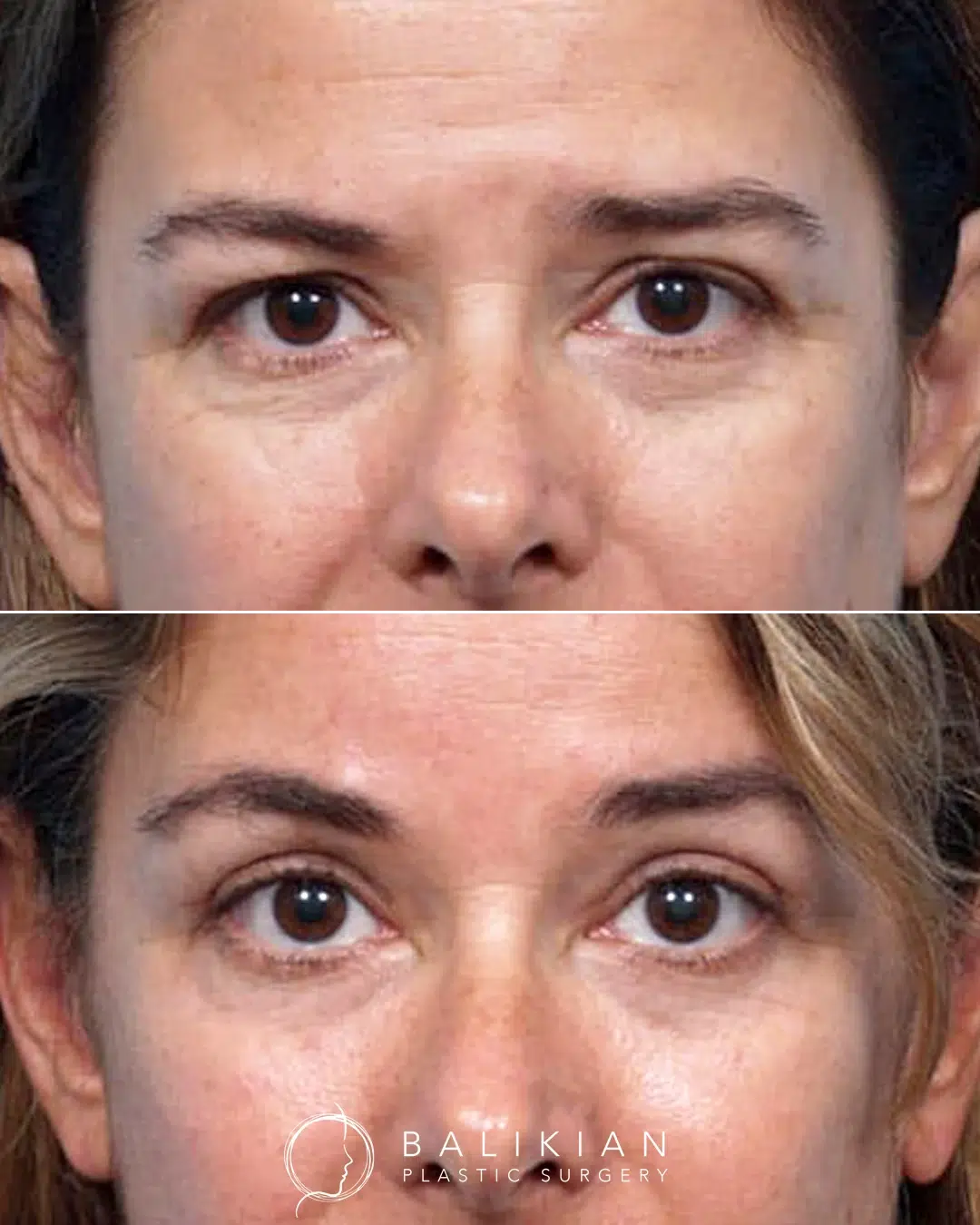 Blepharoplasty before and after photo, female front view.