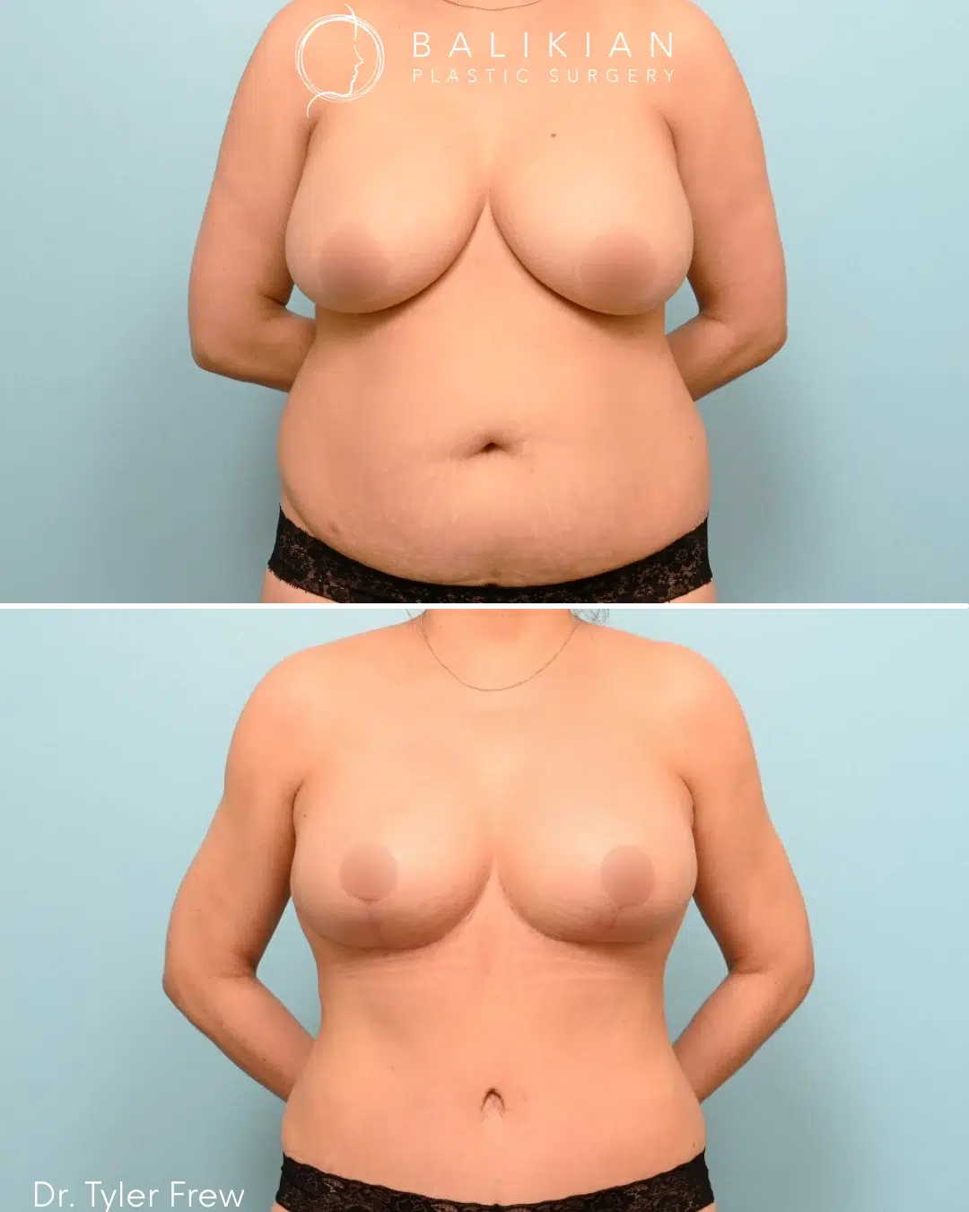 Front view before and after photo of a Mommy Makeover patient. The before image shows drooping breasts and excess skin on the abdomen. The after image shows symmetrical, perky breasts and a sculpted midsection after breast lift, augmentation, and tummy tuck surgery.