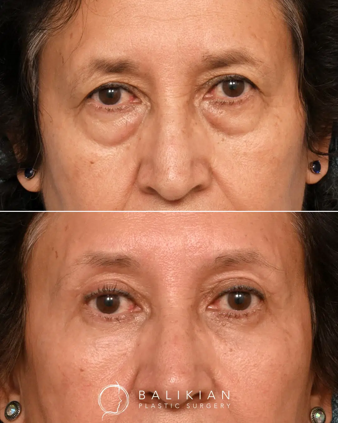 Before and after photos of eyelid surgery front view.