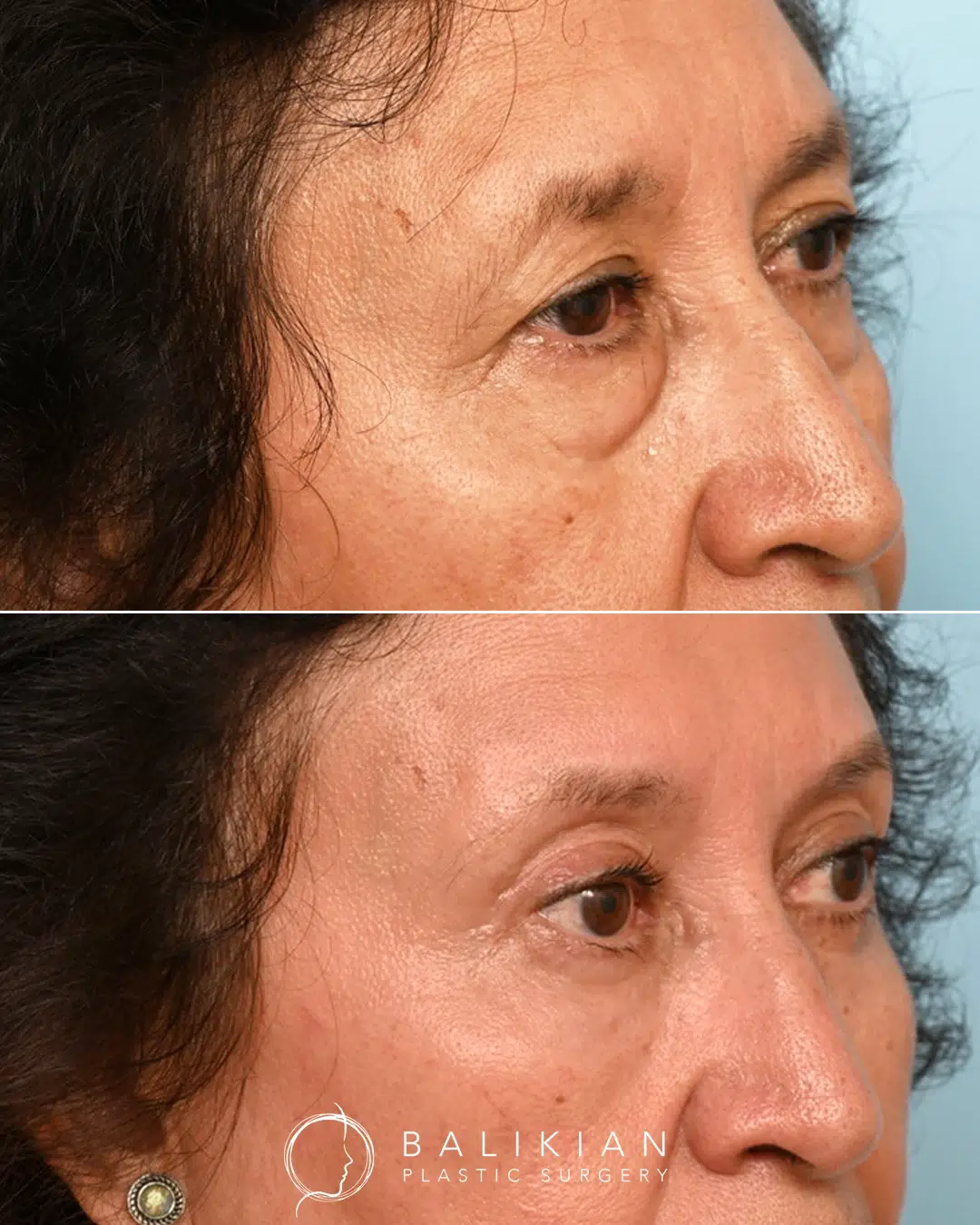 Before and after photos of eyelid surgery oblique view.