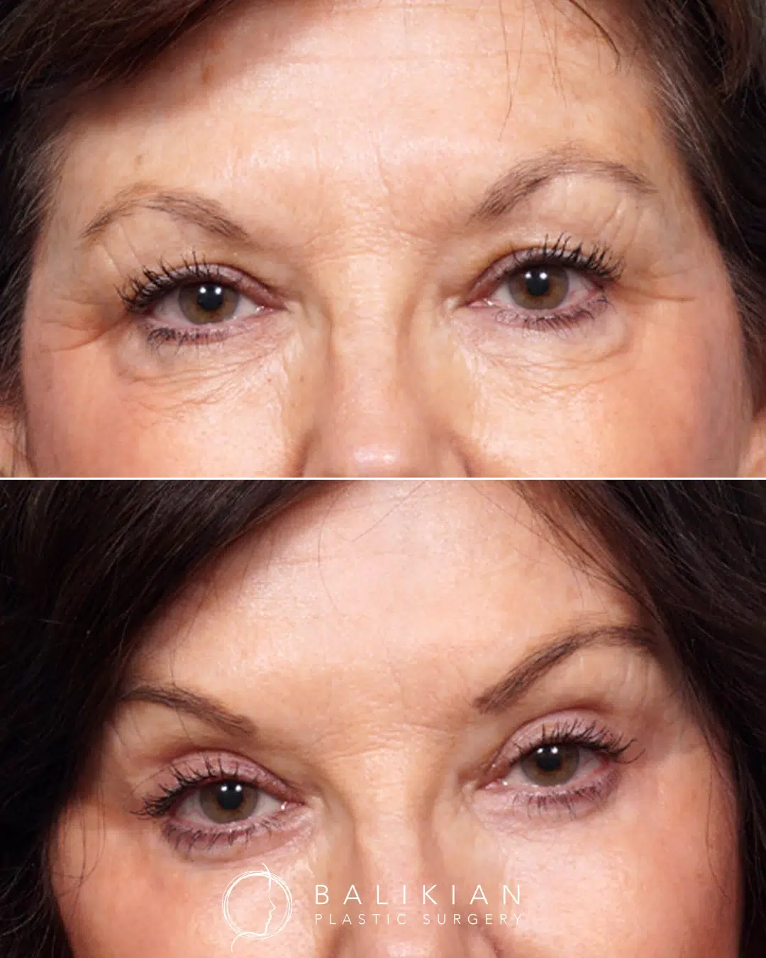 Before and after pictures of eyelid surgery, female patient.
