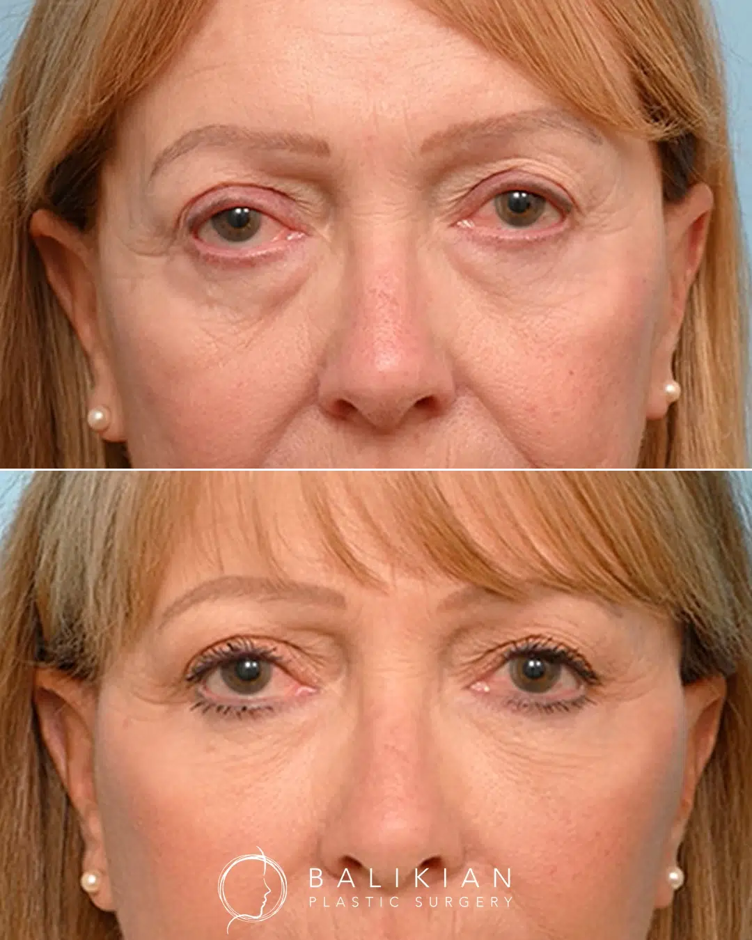 Blepharoplasty before and after front view.