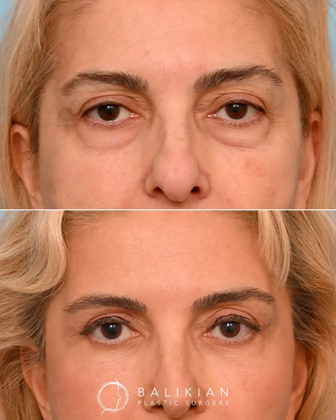 Bleph before and after photo, front view.