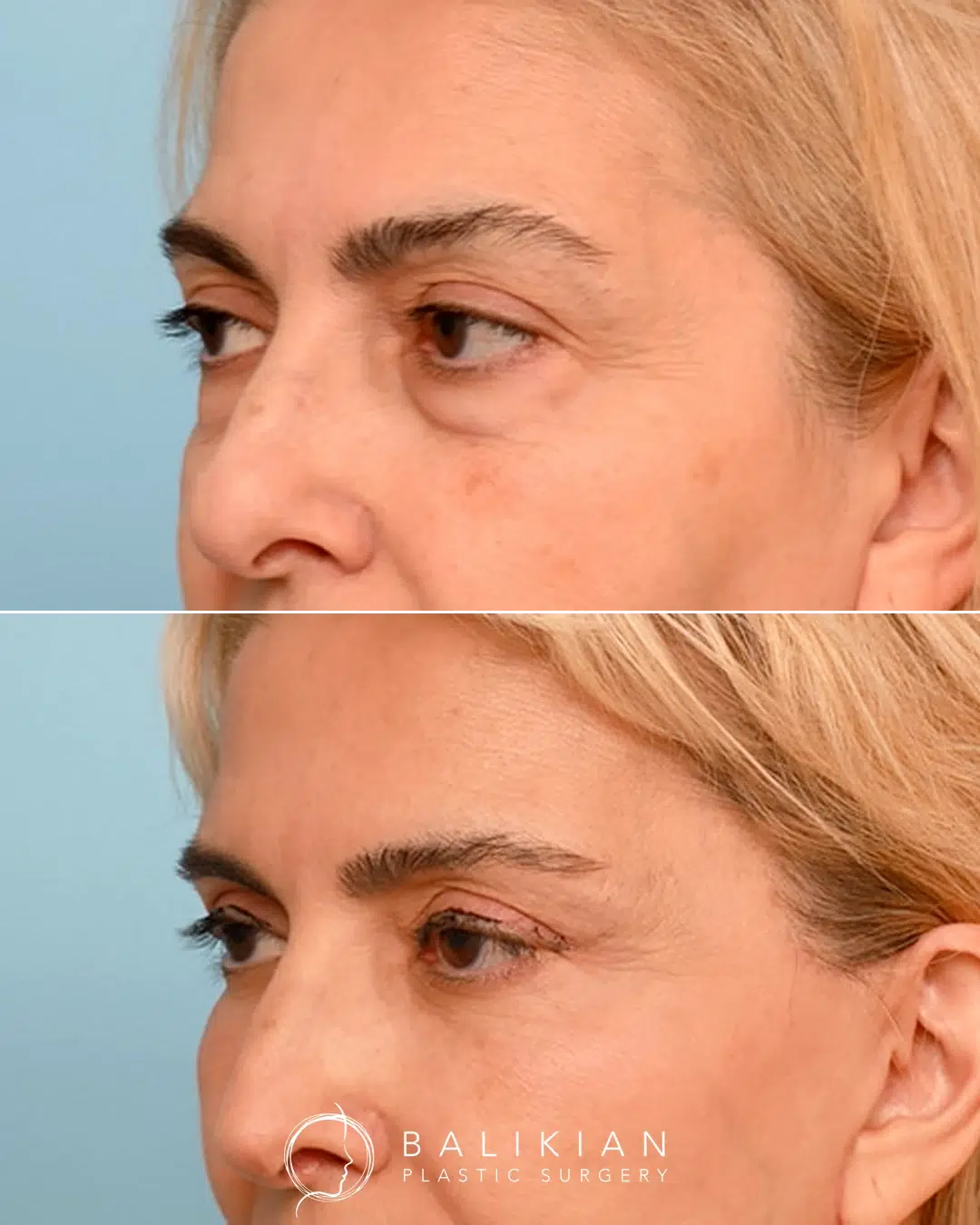Bleph before and after photo, oblique left view.