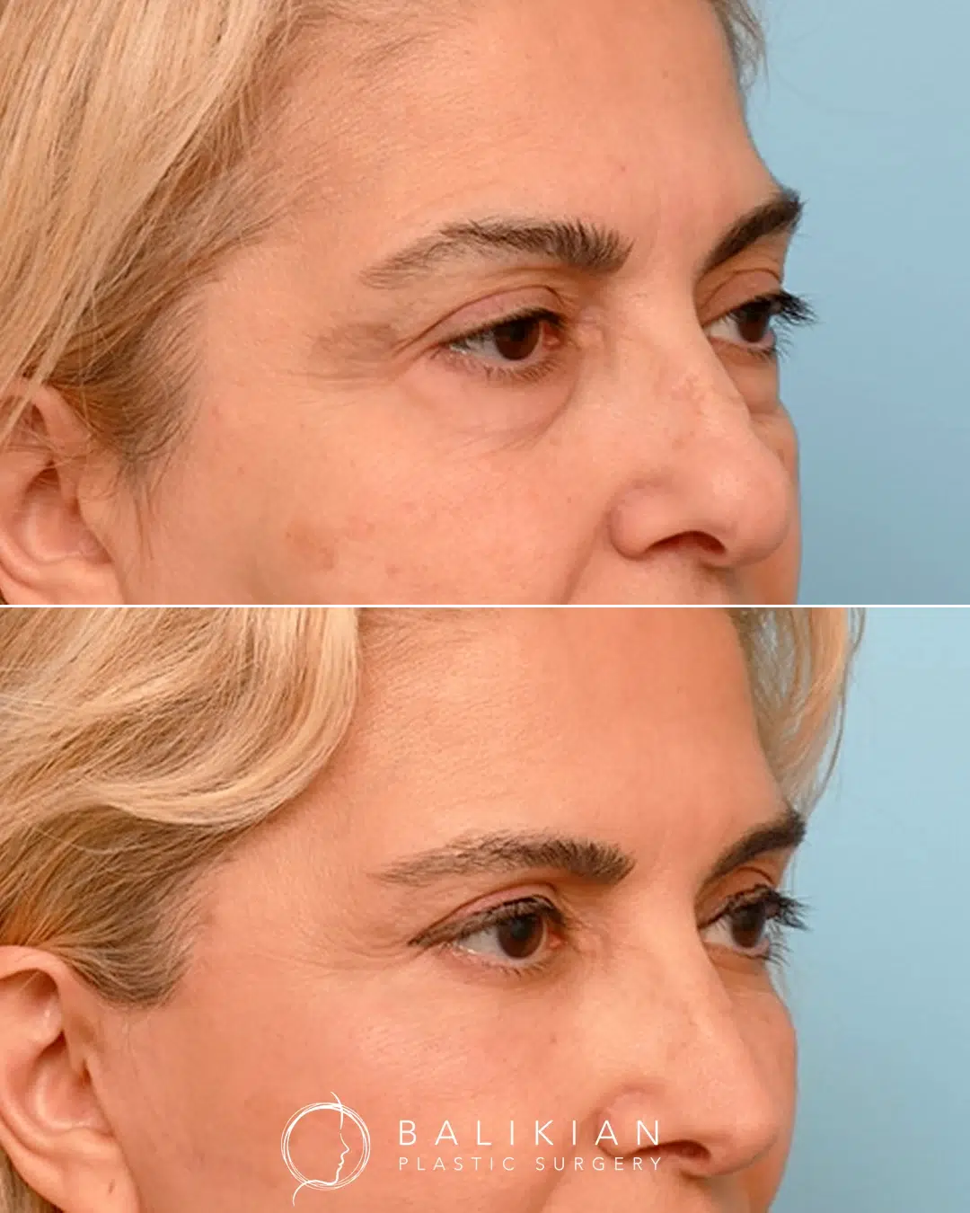 Bleph before and after photo, oblique right view.