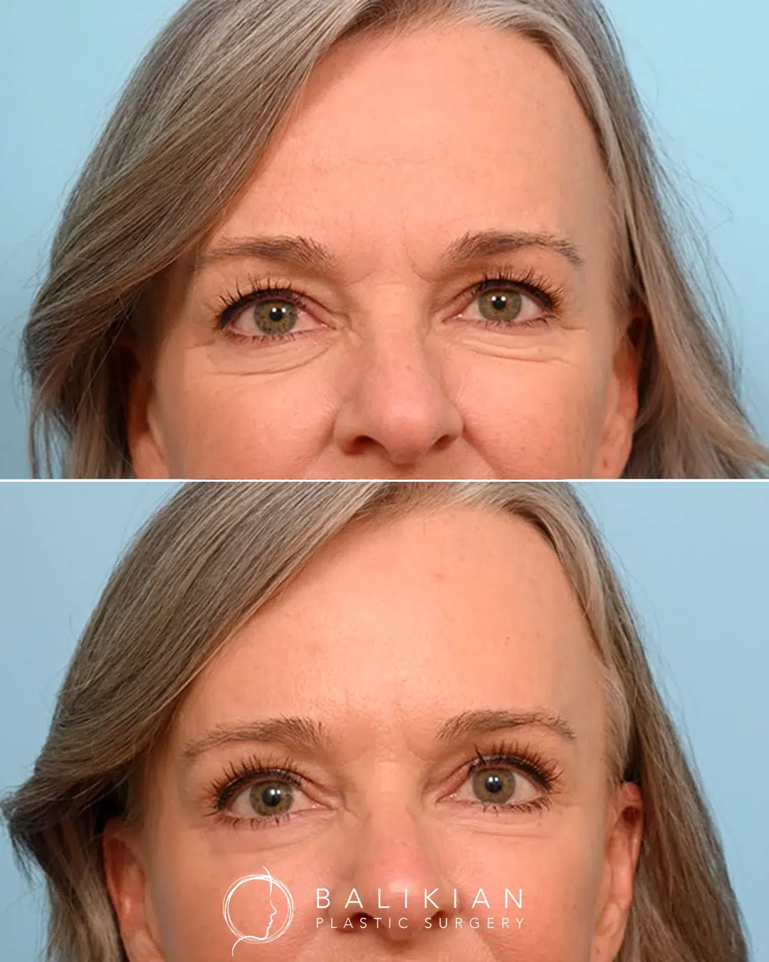 Blepharoplasty before and after eyes open front view. Female patient shows smoother eyelids and refreshed appearance after surgery.
