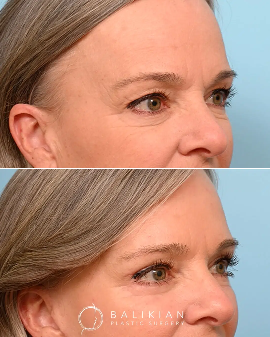 Blepharoplasty before and after side view. Female patient demonstrates improved eyelid contour and youthful eye rejuvenation.