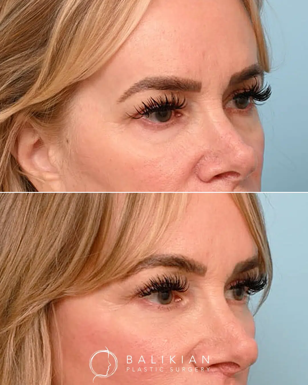 Lower eyelid blepharoplasty before and after, female side view. Noticeable reduction in puffiness and under-eye bags.