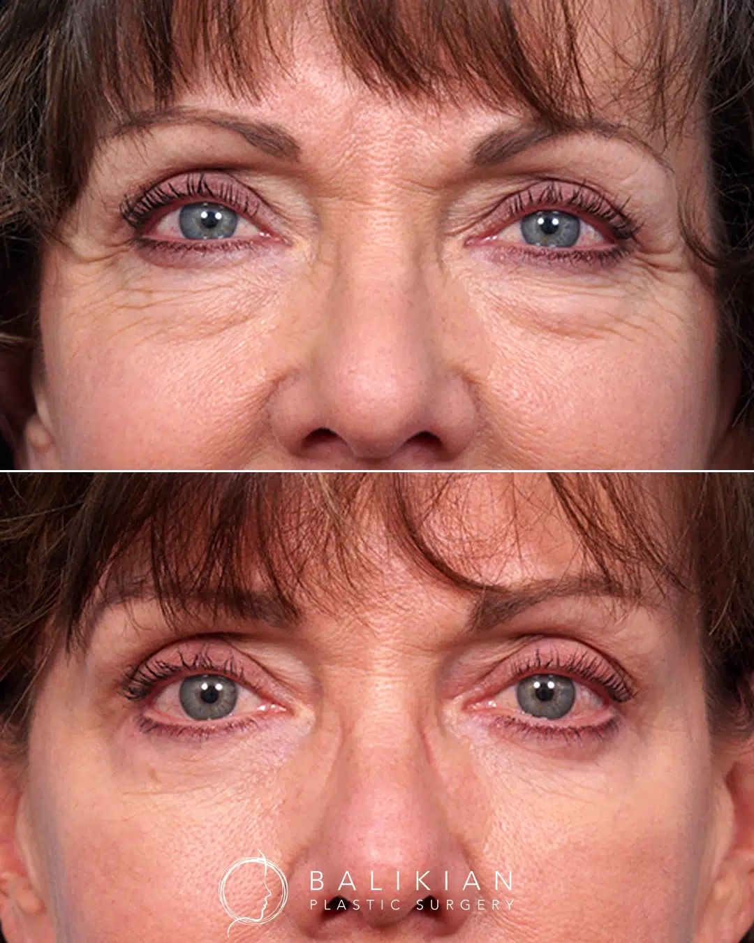 Blepharoplasty before and after pictures, female front view. Results highlight brighter, more open eyes and smoother upper eyelids.