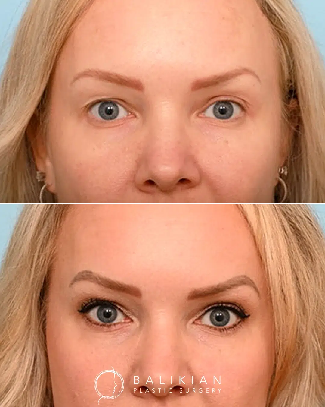 Blepharoplasty before and after pictures front view. Patient shows reduced eyelid heaviness and natural eye rejuvenation.