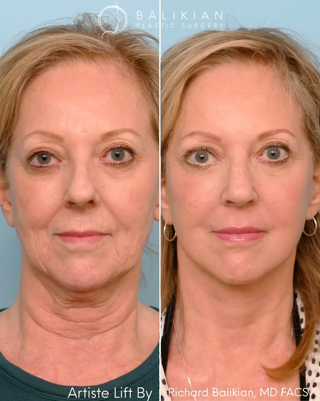 Deep plane facelift before and after front view. Artiste Lift™ results highlight defined jawline, softened folds, and a refreshed overall appearance.