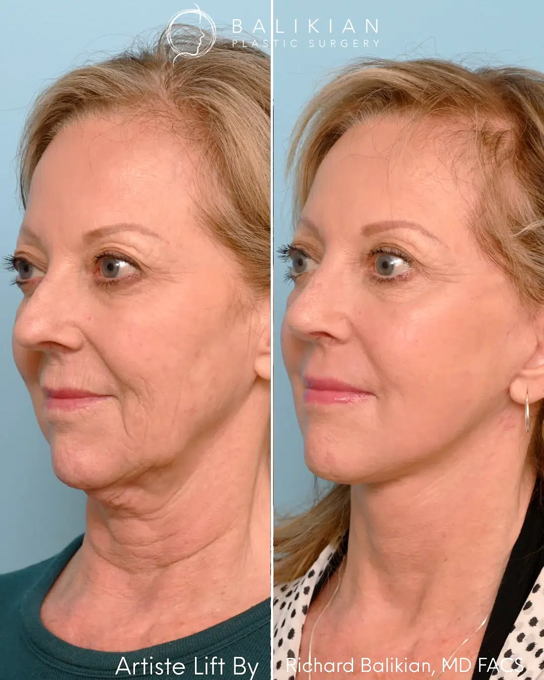 Deep plane facelift before and after oblique left view. Patient demonstrates refined jawline, restored cheek volume, and youthful neck contour.