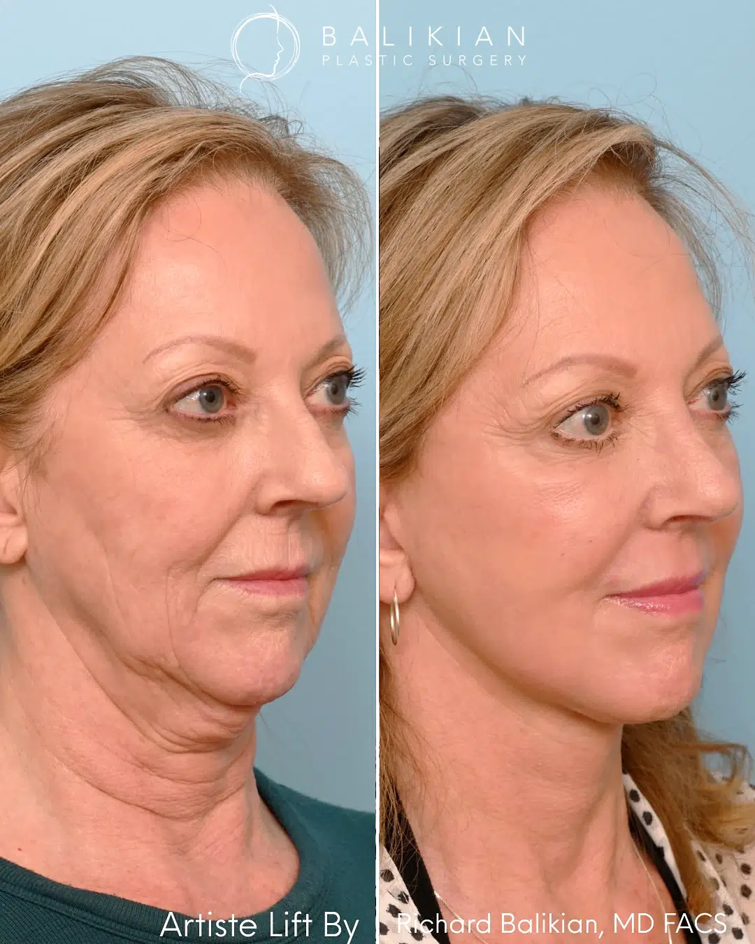 Deep plane facelift before and after oblique right view. Artiste Lift™ results show smoother neckline, reduced jowling, and natural midface lift.