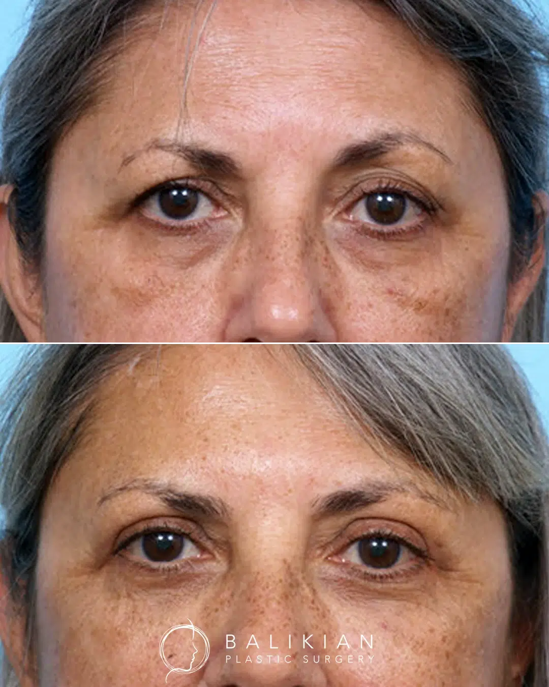 Eye lift before and after female front view. Upper eyelid lift creates a refreshed, more youthful appearance.
