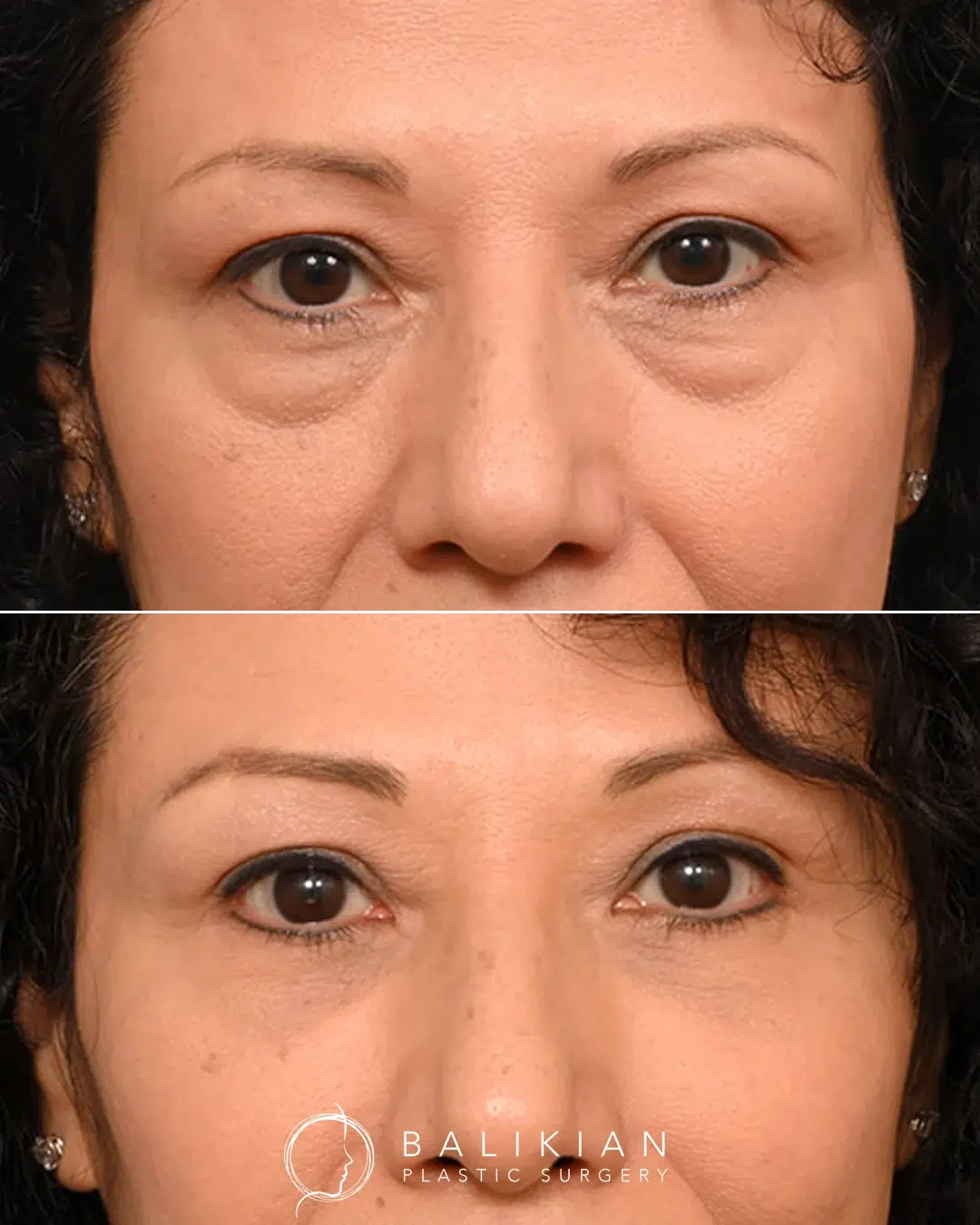 Eye lift before and after lower lids, female front view. Reduction in under-eye bags and smoother lower eyelid contour.