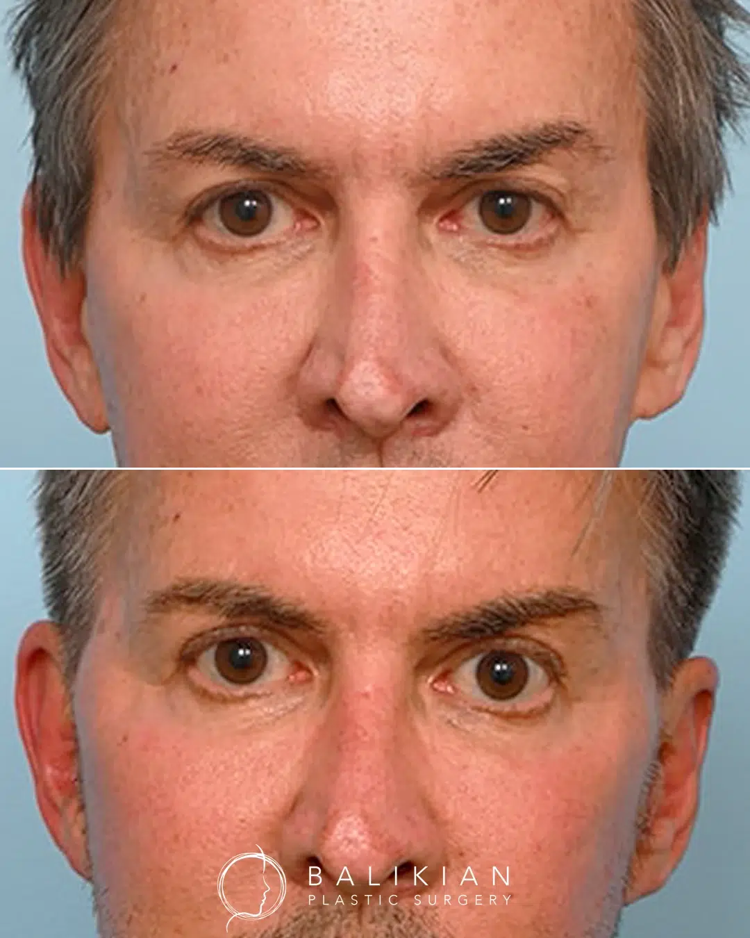 Eye lift before and after male front view. Patient demonstrates tighter upper eyelids and natural eye rejuvenation.