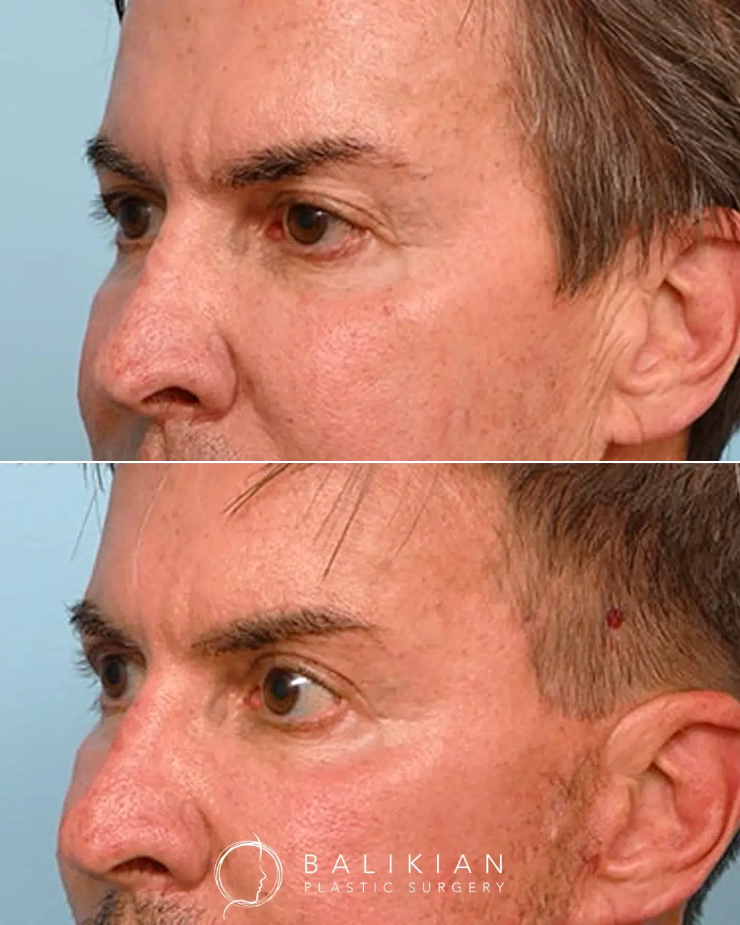 Eye lift before and after male oblique left view. Results show improved eyelid shape and reduced puffiness.