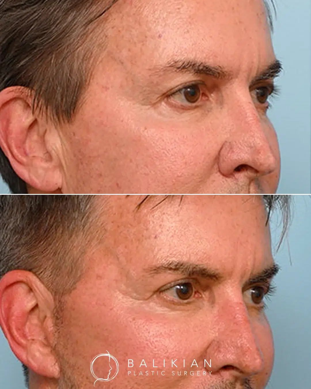Eye lift before and after male oblique right view. Noticeable improvement in upper eyelid heaviness and youthful eye contour.