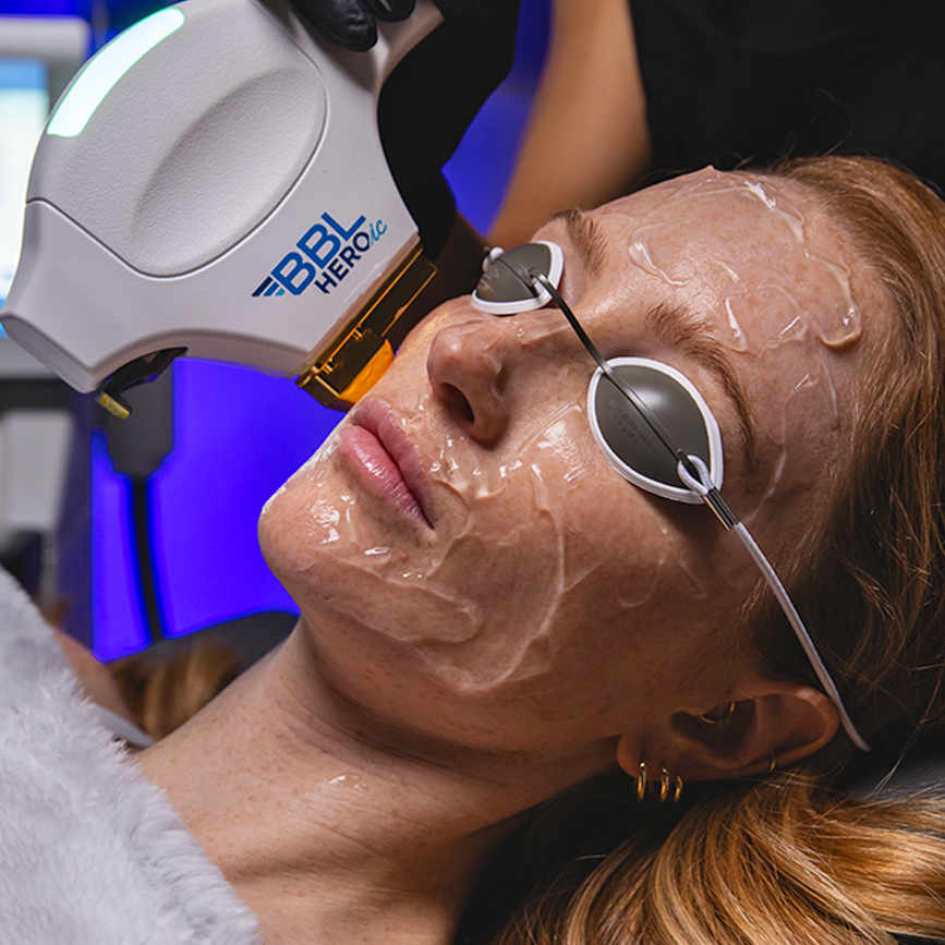 BBL HEROic handpiece with cooling gel treating the face to calm acne and reduce inflammation.