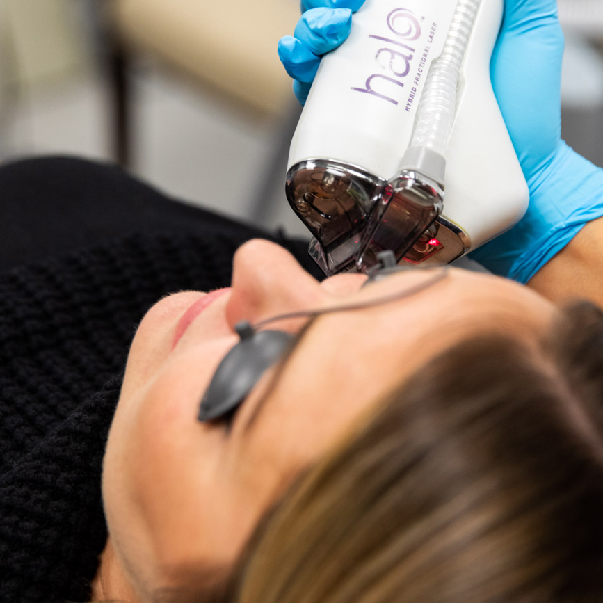 Halo hybrid fractional laser handpiece treating facial skin while the patient wears protective goggles.