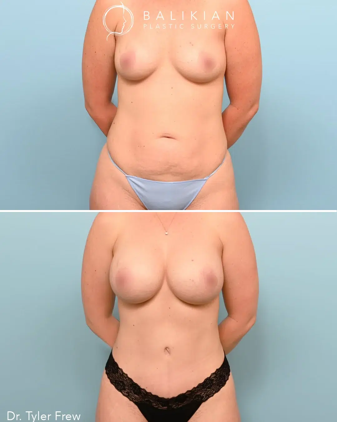 Front-facing before and after photo of a Mommy Makeover patient. The before image shows loose abdominal skin, sagging breasts, and postpartum changes. The after image shows natural, symmetrical breasts, a smooth waistline, and overall improved body contour.