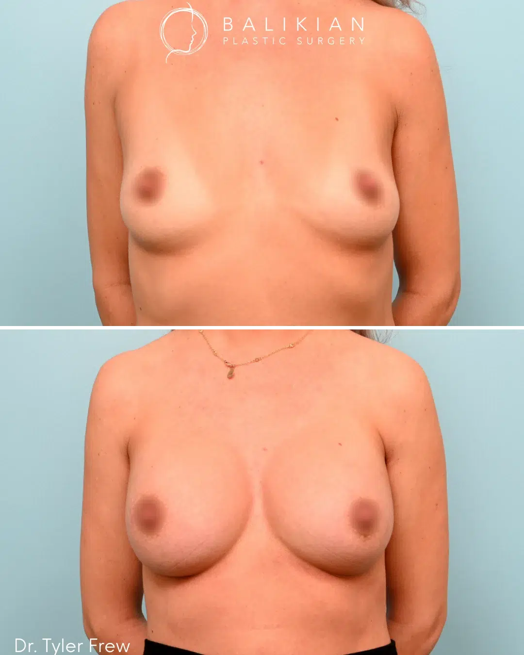 Front view before and after breast augmentation with silicone implants and internal bra support. Symmetry and volume improved.
