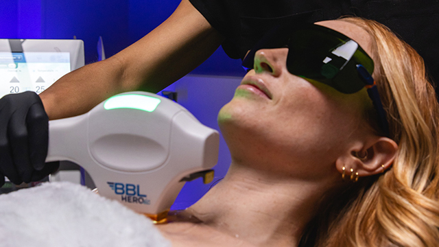 Patient receiving BBL HEROic laser treatment for hyperpigmentation on the chest while wearing protective eye shields