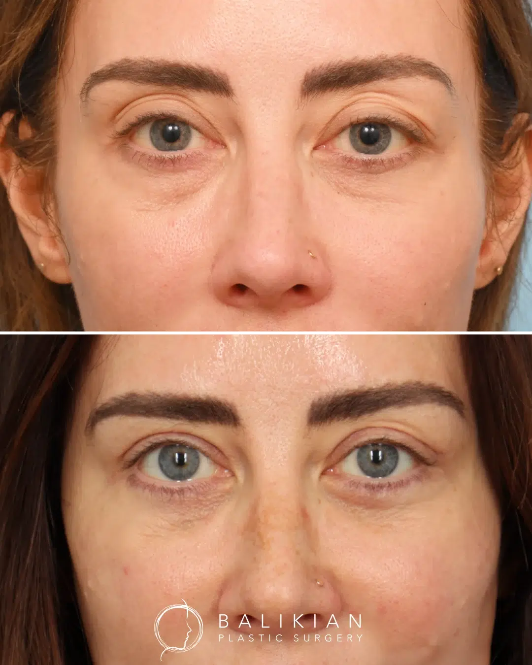 Before and after photos displaying reduced eye bags and restored eyelid smoothness after blepharoplasty for under-eye rejuvenation.