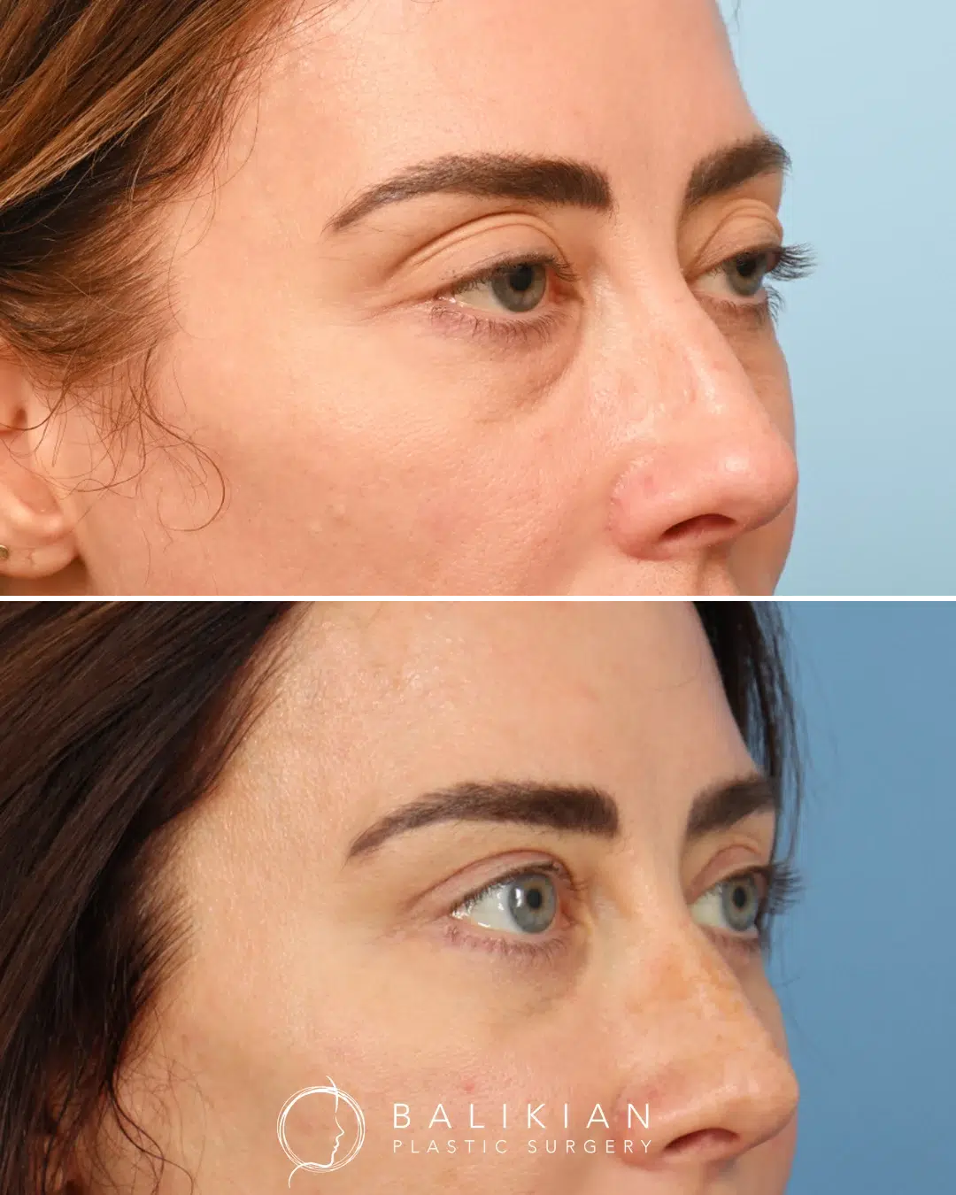 Before and after photos showing softened under-eye fullness and smoother skin after lower eyelid blepharoplasty.