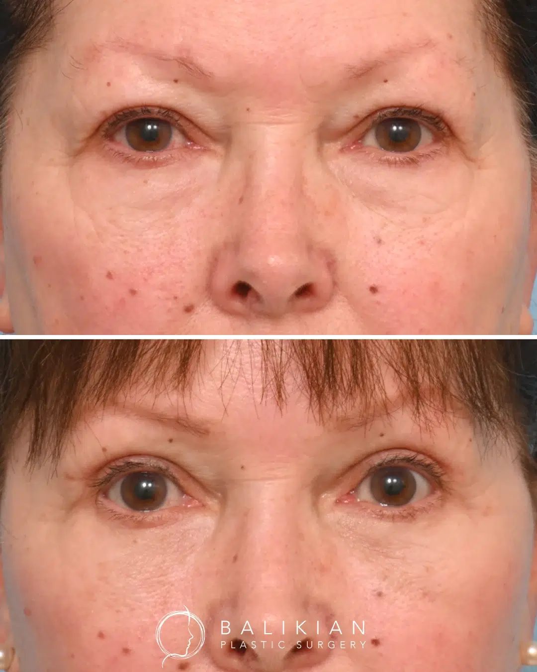 Before and after photos showing refreshed, well-defined eyes and smoother lower eyelids after cosmetic blepharoplasty.