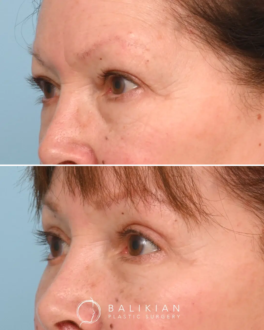 Before and after photos showing tighter upper eyelid skin and smoother under-eye area following eyelid rejuvenation surgery.
