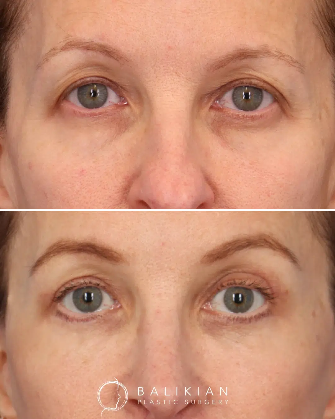 Before and after photos revealing brighter, more youthful eyes with improved eyelid tone and definition after upper and lower blepharoplasty.