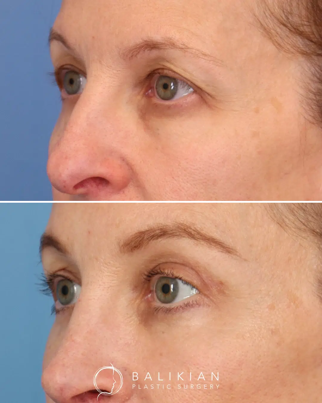 Before and after photos showing balanced eyelid symmetry and reduced heaviness beneath the eyes.