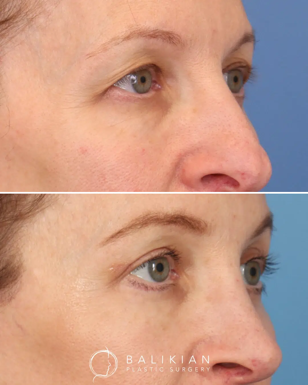Before and after photos displaying smoother lower eyelids and a refreshed upper lid crease following blepharoplasty.