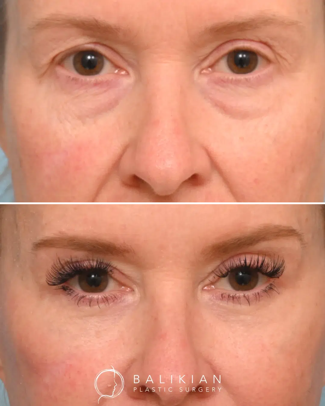 Before and after photos showing more open, rested eyes and a balanced appearance following upper and lower eyelid surgery.