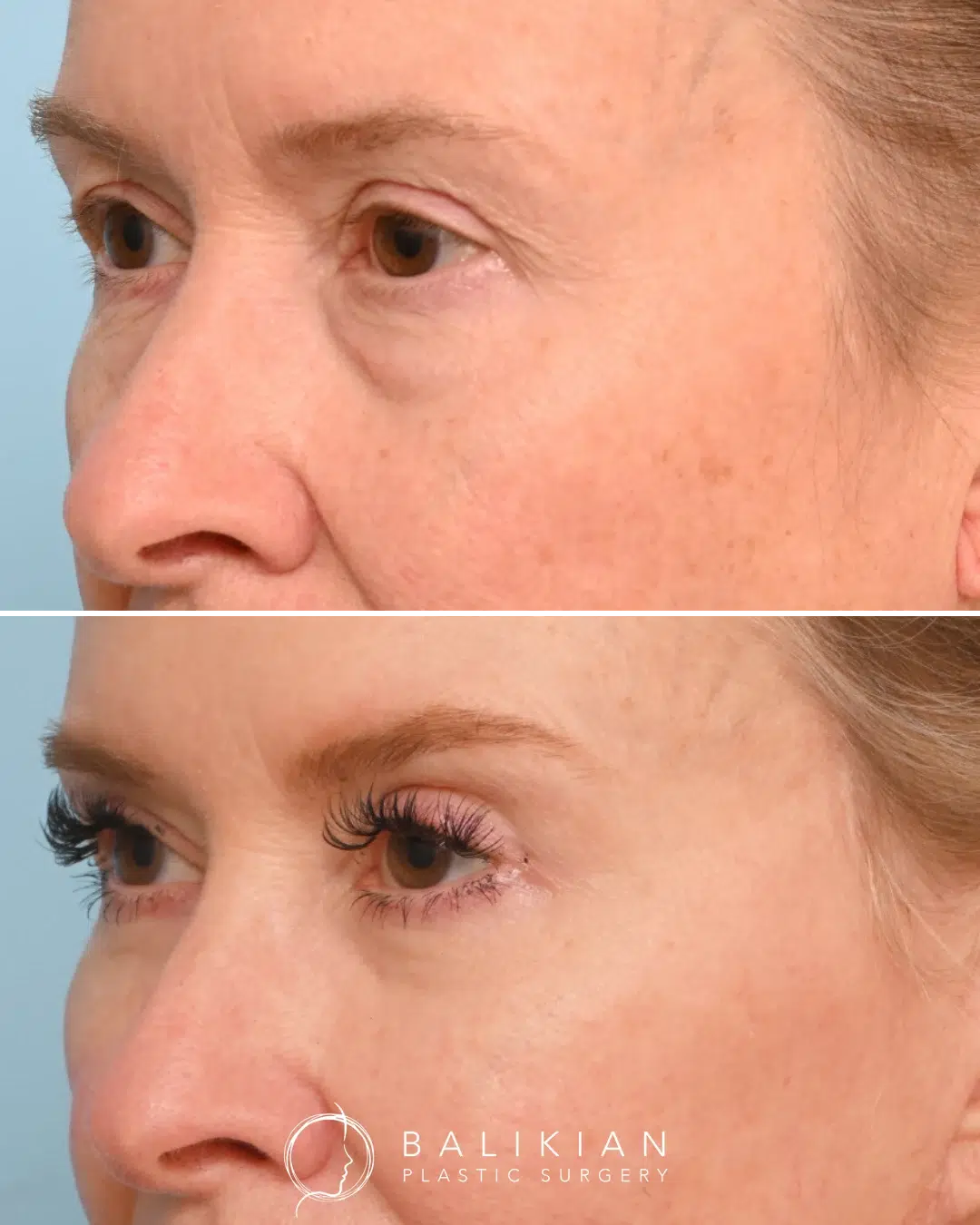 Before and after photos highlighting natural upper and lower eyelid rejuvenation with improved definition and reduced puffiness.