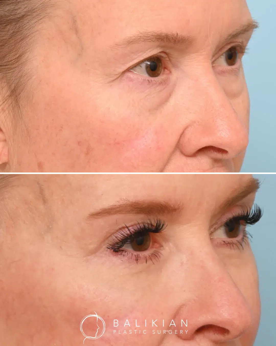 Before and after photos showing smoother lower eyelids and a refreshed upper eyelid contour after blepharoplasty, creating a brighter, more youthful look.