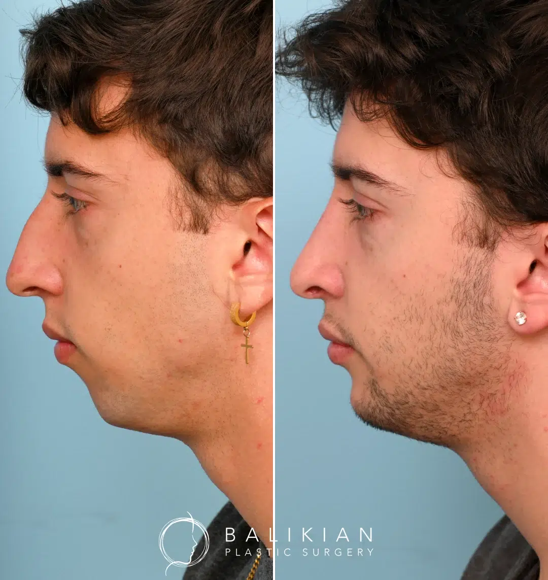 Male patient shown in side profile before and after chin augmentation surgery. The chin appears stronger and more defined, enhancing facial balance and jawline contour.