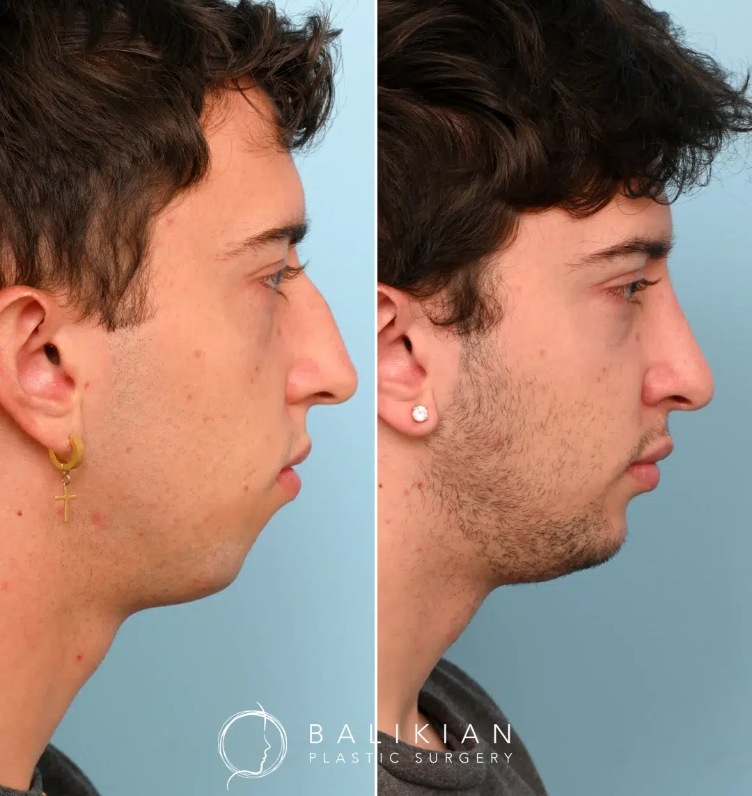 Side profile of a male patient before and after chin augmentation surgery. The after photo shows improved chin projection and a more balanced profile achieved with a silicone chin implant.