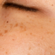 Close-up of cheek skin with visible sun spots and brown hyperpigmentation, showing uneven tone before laser treatment.