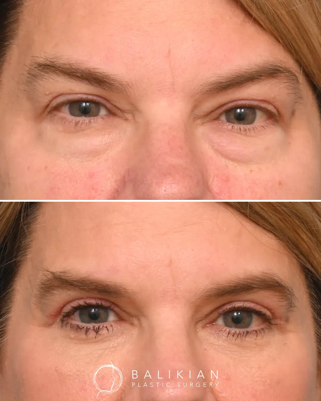 Before and after photos showing rejuvenated, more open eyes with diminished under-eye bags and natural-looking upper eyelid definition.