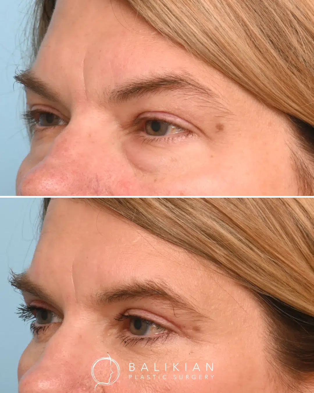 Before and after photos highlighting improved eyelid contour and reduced puffiness after upper and lower eyelid surgery.