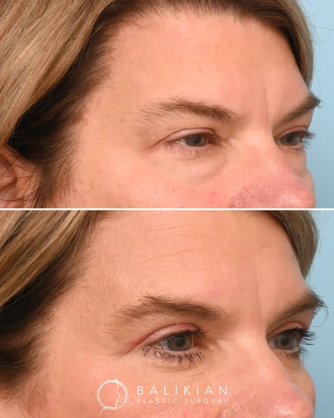 Before and after photos showing smoother, firmer lower eyelids and lifted upper eyelids following bilateral upper blepharoplasty and lower transconjunctival blepharoplasty.